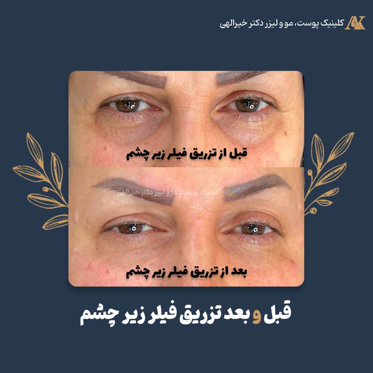 عکس قبل و بعد از تزریق ژل زیر چشم